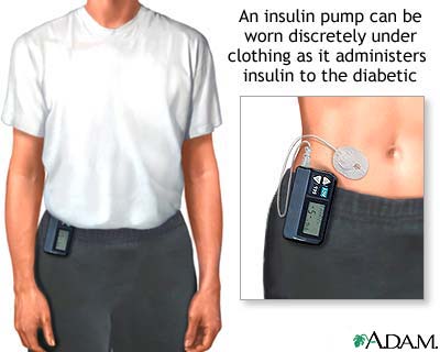 insulin-pump-1.jpg